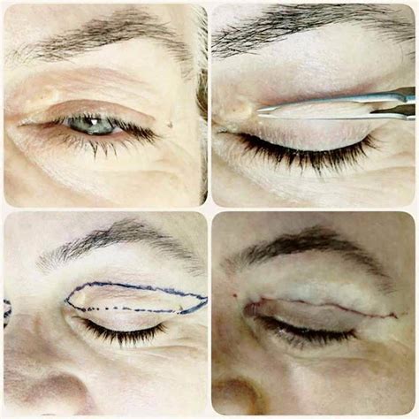 Before And After Eyelid Surgery In Tampa Fl Eyelid Surgery Cost Photos Rewiews Qanda