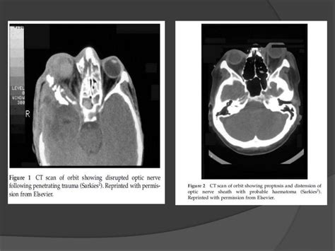 Traumatic optic neuropathy