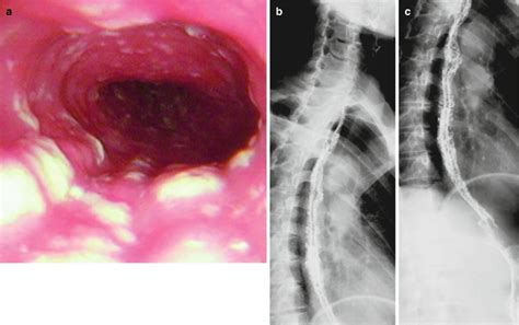 CMV Esophagitis As Related To HIV Infection Pictures