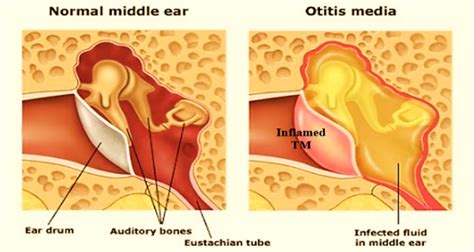 Ear Acute Otitis Media Dr Meenesh Juvekar Ent Specialist