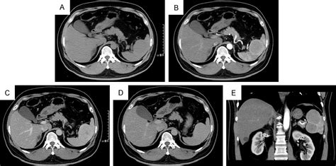 Figure From Multimodality Imaging Of Spleen Involvement In Erdheim