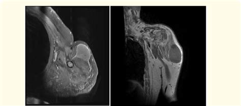 mri images  shoulder  scientific diagram