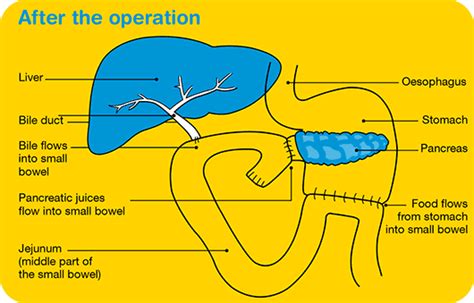 Treatment For Early Pancreatic Cancer Cancer Council Victoria