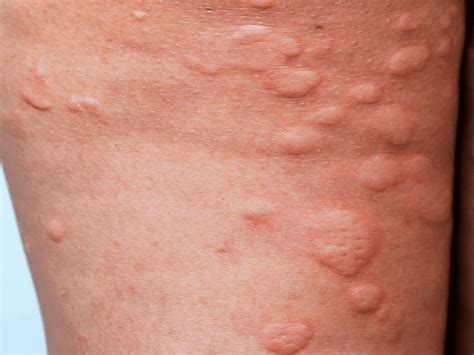 Hives Stratum Dermatology Clinics