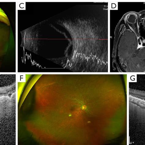 A Case Of Non Infectious Posterior Scleritis A 57 Year Old Woman