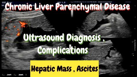 Chronic Liver Disease Ultrasound Cirrhosis Mass Ca Hepatoma