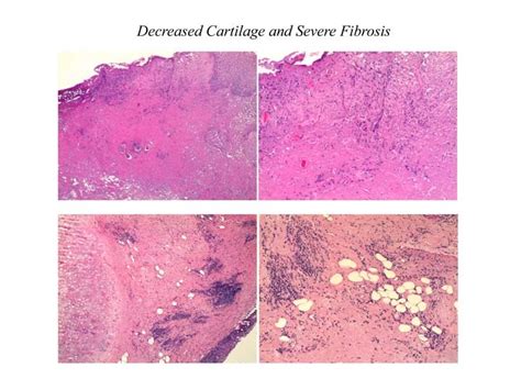 CASE AT A GLANCE: Partial Epiglottis Removal After Tongue Cancer ...