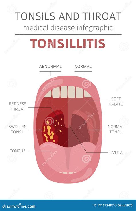 Am Gdalas Y Enfermedades De La Garganta S Ntomas De La Tonsilitis