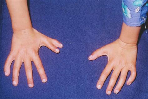 Ectodermal Dysplasia Hands