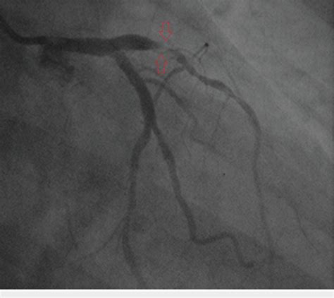 Angiogram showing thrombotic occlusion of the proximal LAD artery. LAD ...