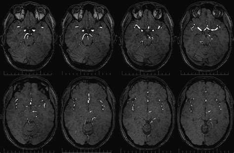 Patent Foramen Ovale Associated With The Unusual Presentation Of