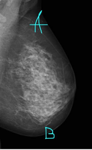 Breast Imaging Flashcards Quizlet