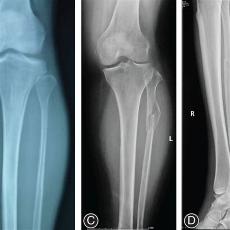 Manifestations of proximal fibular fractures. (A) Fibular neck ...