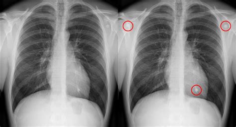 Chest X Ray Quality Normal Chest X Ray With Artifact