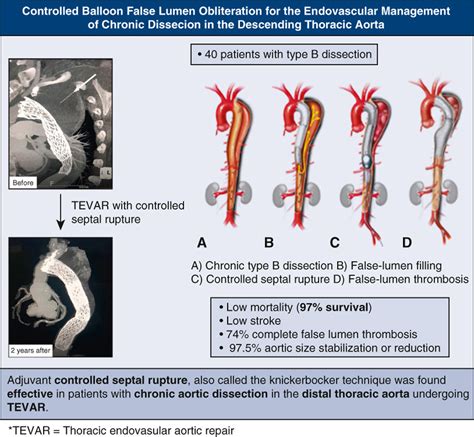 Controlled Balloon False Lumen Obliteration For The Endovascular