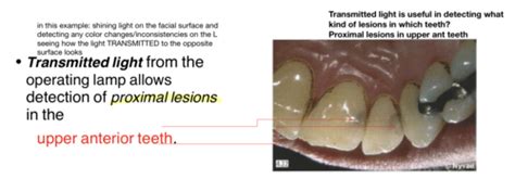 Caries Diagnosis Flashcards Quizlet