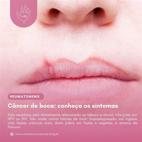 Mancha Marrom Na Boca - Câncer de boca: conheça os sintomas e saiba como prevenir a doença ...