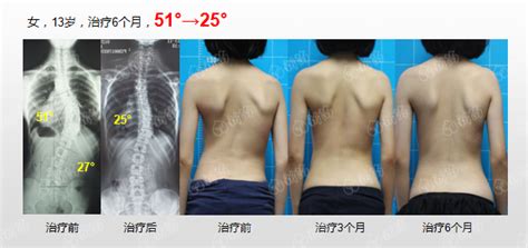 脊柱侧弯普查筛查报道广东省新苗脊柱侧弯预防中心 脊柱侧弯新苗基金