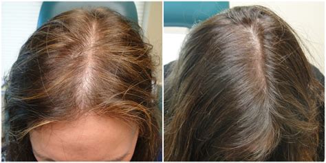 PRP for Hair Loss - Dr MediSpa Award Winning Clinics