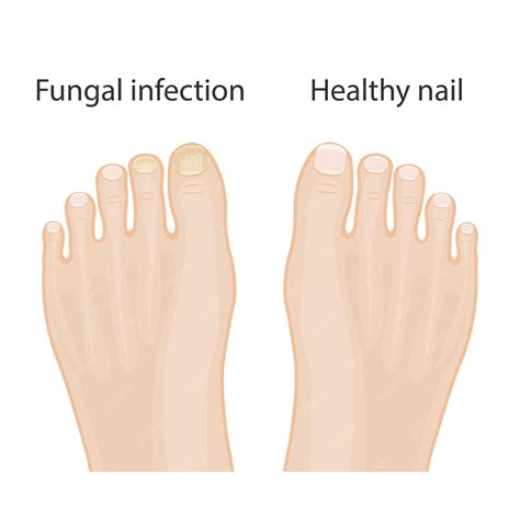 Premium Vector | Nail diseases Onychomycosis causes of fungal nail infection Medical infographic ...