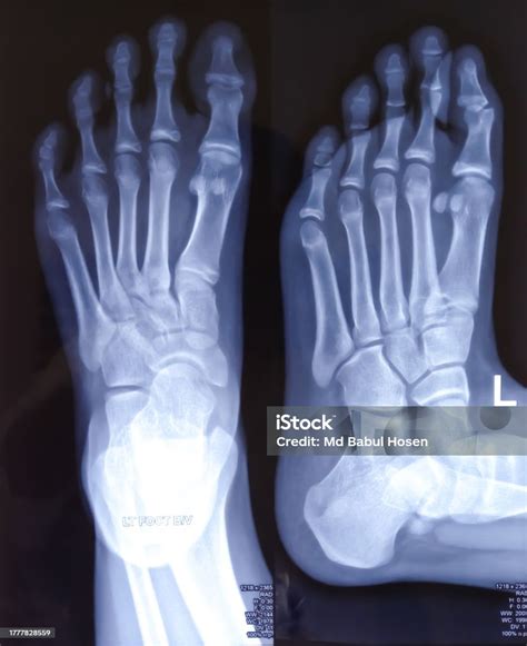 Xray Or Radiograph Of An Ankle Showing Anatomy Of Bones And Joint Of ...