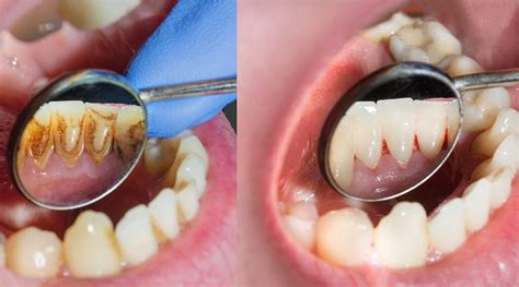 Are You Getting A Deep Dental Cleaning This Is What You Need To Know