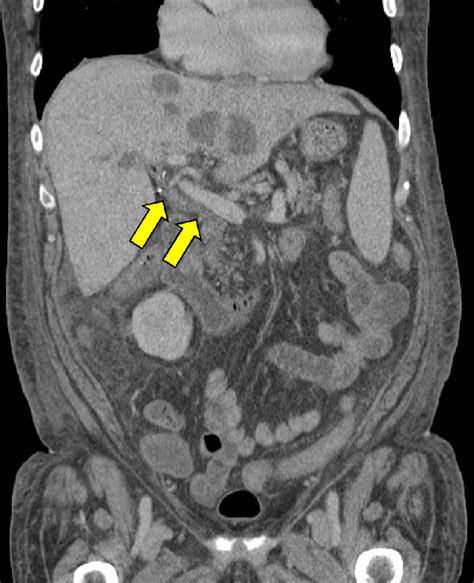 Post Ercp Ct Shows Resolution Of The Cbd Filling Defect And Associated Download Scientific