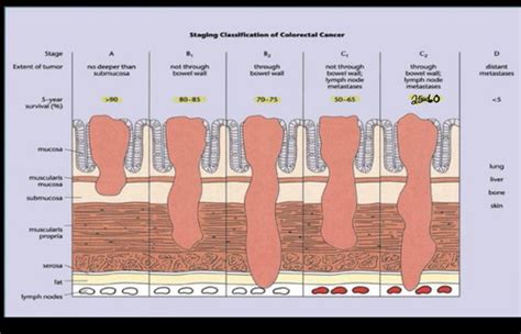 Colorectal Cancer Flashcards Quizlet