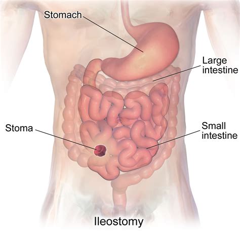 Ileostomy Loop Ileostomy End Ileostomy Diet Complications