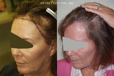 Forehead Reduction Surgery Photos Miami FL Patient37136