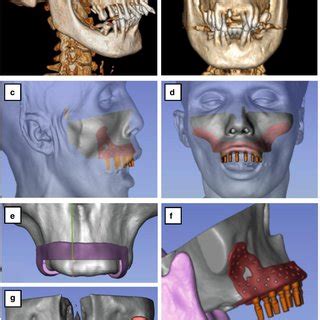 D Computed Tomography Scan Of The Patients Skull A B Frontal Lateral