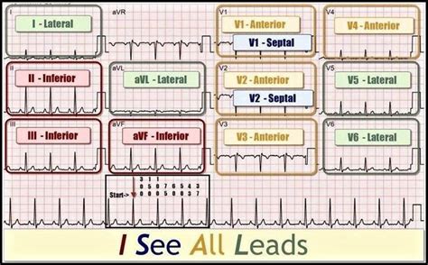 12 Lead STEMI Cheat Sheet