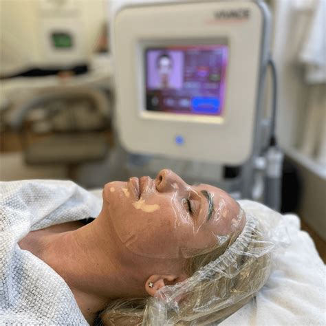 RF лифтинг в Киеве: Микроигольчатый РФ лифтинг лица и тела – Kika-Style