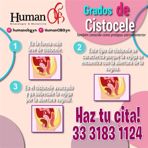 ⛔ El cistocele puede aparecer... - Ginecologia & Obstetricia
