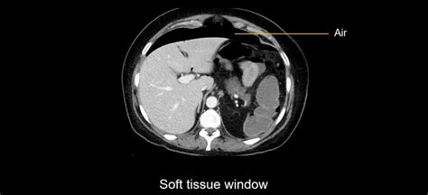 Abdominal Ct Bowel Perforation • Litfl • Radiology Library