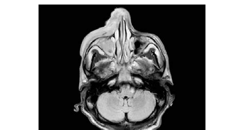 Mri Of The Orbit Face And Neck Axial T2 Flair Diffuse Edema Of