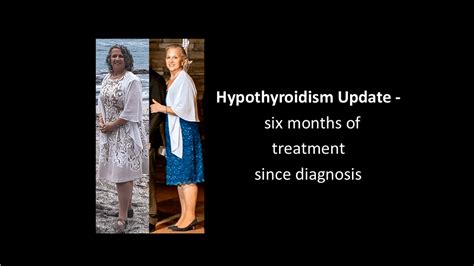 Hypothyroidism Update Six Months Of Treatment Since Diagnosis