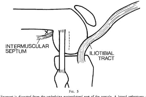 Figure 5 From Combined Anterior Cruciate Ligament Reconstruction Using