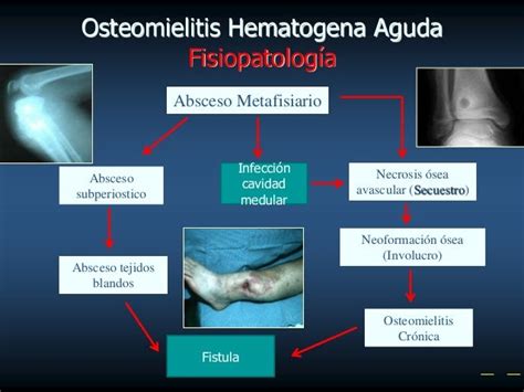 Osteomielitis Y Artritis Septica