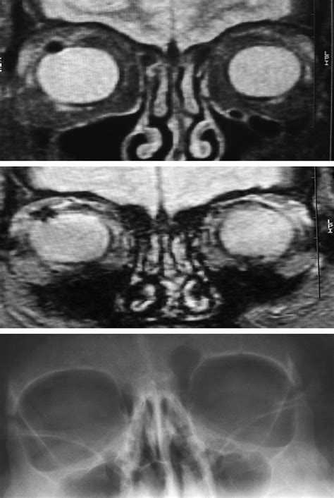 Screening For Intra Orbital Metallic Foreign Bodies Prior To Mri