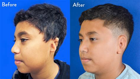 Year Old Male With Bilateral Grade Microtia Before And After Rib