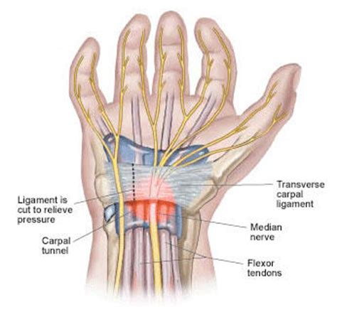 Neuritis Median Neuritis