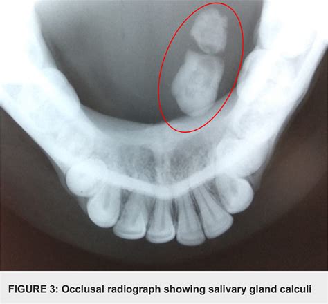 Figure From Sialolithiasis Of The Submandibular Gland Report Of