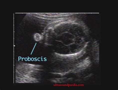 Holoprosencephaly – alobar – ULTRASOUNDPAEDIA