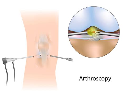 Arthroscopy Of The Knee Knee Scope Schulze Orthopedics