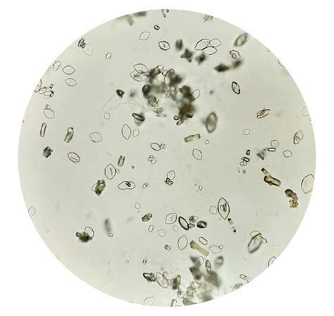 Premium Photo Uric Acid Crystals In Urine Sediment It S Different