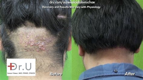 barber's rash back of head, Acne Keloidalis Nuchae -AKN cure - YouTube