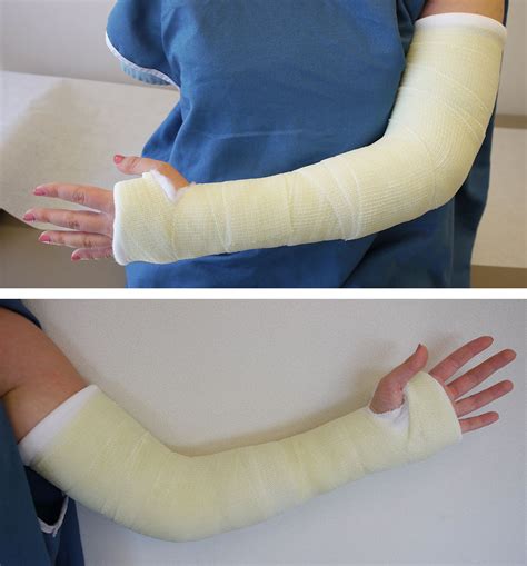Broken Wrist Cast Or Splint at Brunilda Covington blog