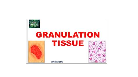 Granulation tissue - Pathology Made Simple