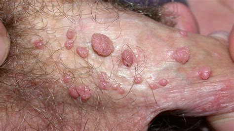 Penile Bacterial Infection